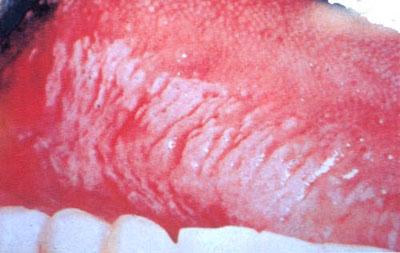 口腔黏膜白斑病是指发生于口腔,口唇等处黏膜的白色角化性疾病.