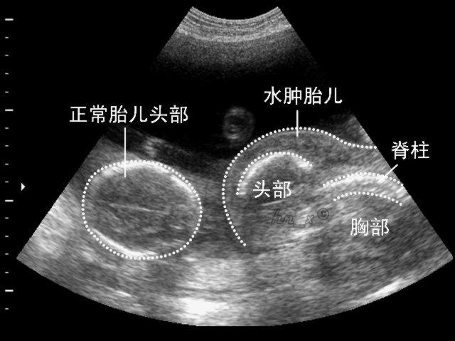 看b超单<em>判断</em>胎儿<em>性别准</em>_社会新闻_播丽堂新闻