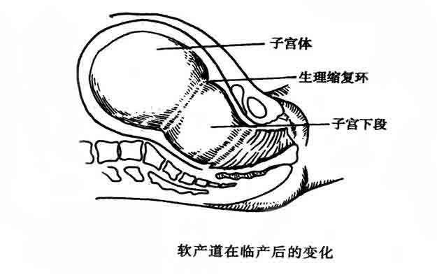 软产道异常性难产