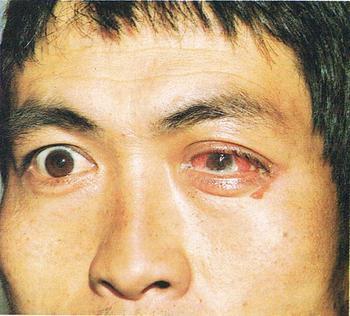 临床特点是眼睑和结膜高度充血水肿,大量脓性分泌物,如不及时治疗,可