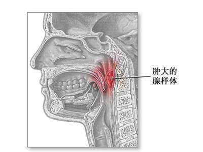 急性腺样体炎