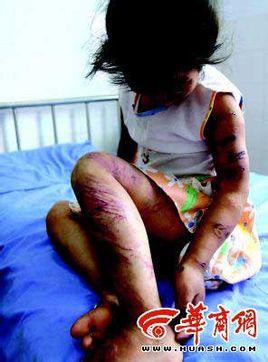 青海省西宁市女童苏丽因受母亲燕志云长年虐待