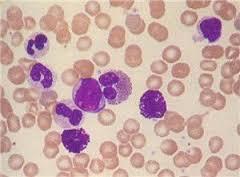 白血病中对诱导分化治疗反应较好的一种类型,这与apl细胞中表达的维a