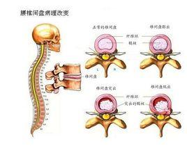 腰间盘膨出