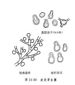 皮炎芽生菌