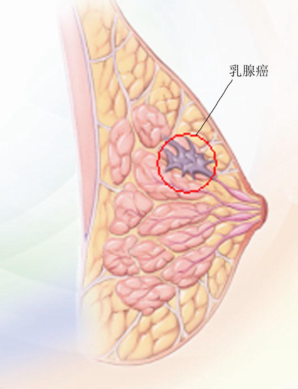 乳腺癌中药方剂