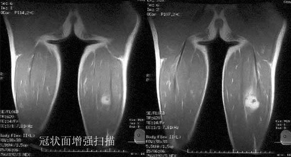 破骨外,形成软组织肿瘤,大的肿瘤可呈多房性,但病变区内无钙化或骨化