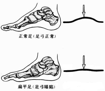 扁平足