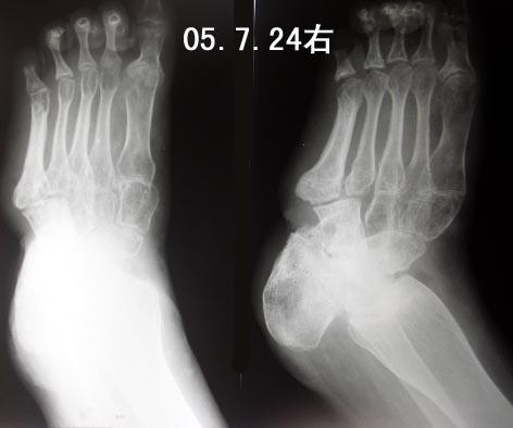 足部x线片:正位片可显示距跟倾斜,侧位片可显示距骨跖屈,负重位的正