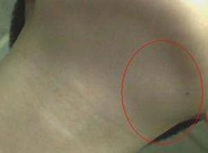 其病症可能是急性淋巴结炎