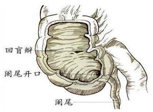 阑尾穿孔严重吗?有什么引起的?怎么治?