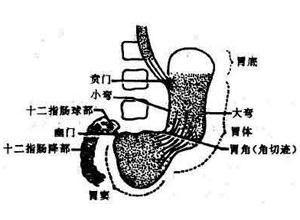 胃窦动力低下是胃轻瘫的临床表现.