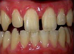 会导致加重牙齿的疼痛,一旦吃硬的东西时,裂缝会加大并且产生剧烈疼痛