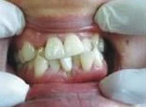牙齿萌出异常