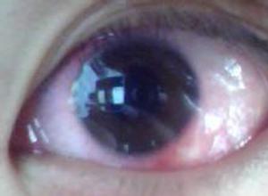 眼睛真菌感染