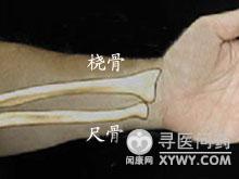 桡骨+尺骨茎突骨折