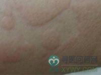麻疹样红斑