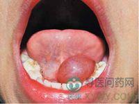 婴幼儿舌下囊肿