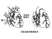 先天性冠状动脉瘤