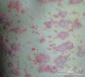 团癣是霉菌引起传染性皮肤病