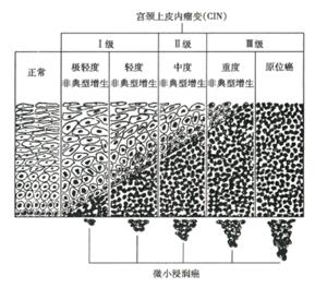 宫颈上皮内瘤变 - 搜狗百科