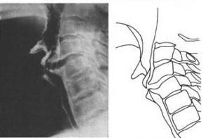 颈椎引起的手痛怎么办 - 颈椎压迫手痛 - 颈椎病人都有不同程度的椎间盘退变