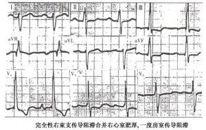 室内传导阻滞