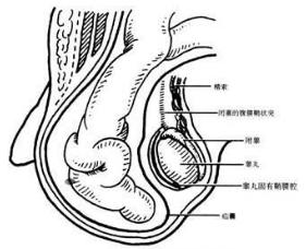 小儿腹股沟斜疝