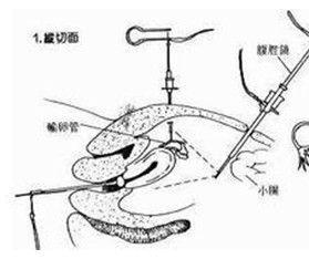 绝育手术指使用羊肠线等将人体或生物体的某些管道(如血管,输精管
