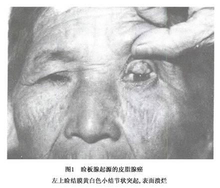 眼睑皮脂腺癌