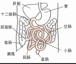 转移性小肠肿瘤