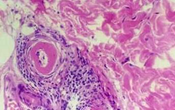 急性多发性神经炎_急性肠胃炎 饼干_急性肠胃