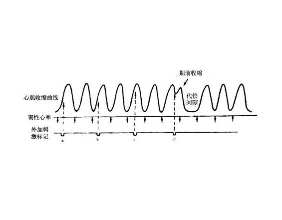 室性期前收缩