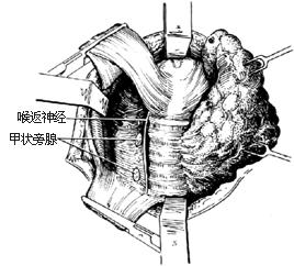 甲状腺结节钙化