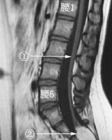 脊髓栓系综合征