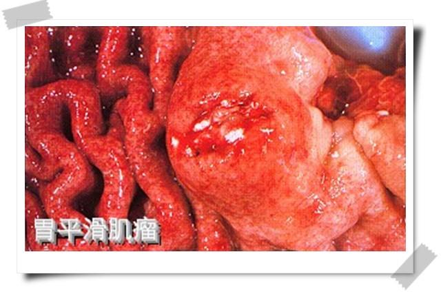 胃平滑肌瘤(leiomyoma of stomach)是起源于平滑肌组织的良性肿瘤是