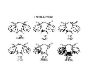 直肠子宫内膜异位症