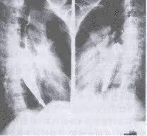 急性腐蚀性食管炎