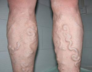 小腿静脉曲张+-+搜狗百科