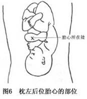 持续性枕后位难产