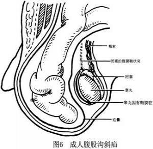 成人腹股沟斜疝