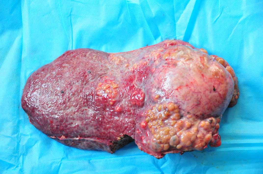 巨块型肝癌