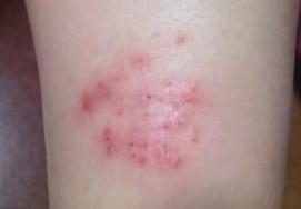 红疹(exanthema),是指丘形小粒