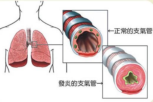 急性支气管炎