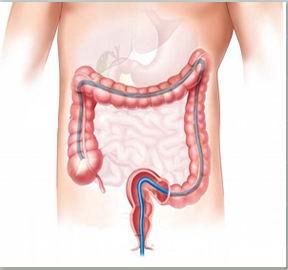 先天性囊袋状短结肠综合征