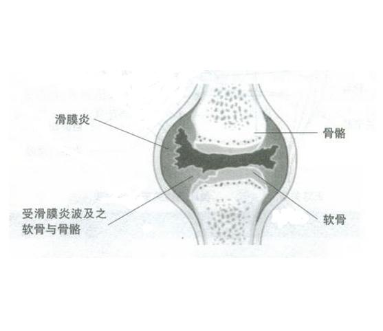 膝盖滑膜炎