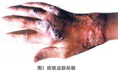 结核系结核杆菌通过皮肤外伤直接感染后发生的增殖性皮肤损害病程缓慢