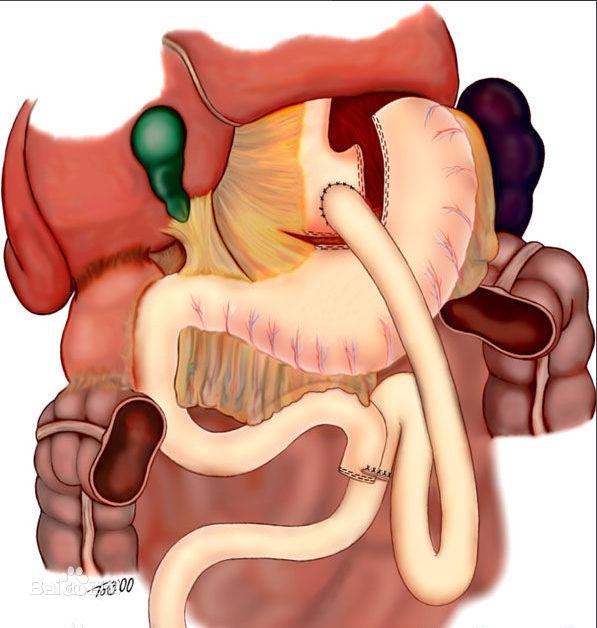 胃旁路手术