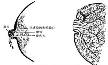 非哺乳期乳晕部瘘管