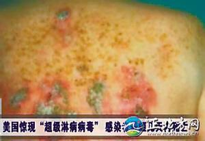 国外研究表明,头孢曲松250mg肌内注射后24h即可清除泌尿生殖道(尿液